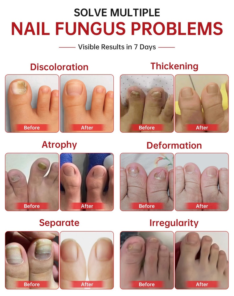 toenail-fungus-treatment-extra-strength--2.jpg