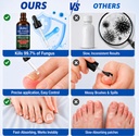 nail-fungus-treatment-25-undecylenic-aci-6.jpg