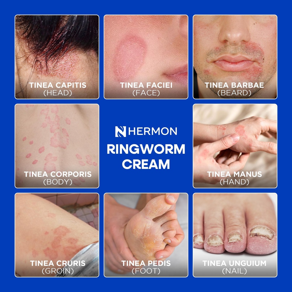hermon-antifungal-ringworm-cream-for-hum-5.jpg