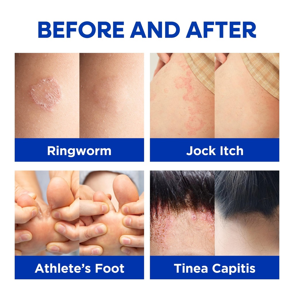 hermon-antifungal-ringworm-cream-for-hum-2.jpg
