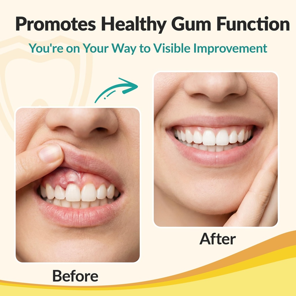 gum-restore-and-gum-repair-for-receding--6.jpg