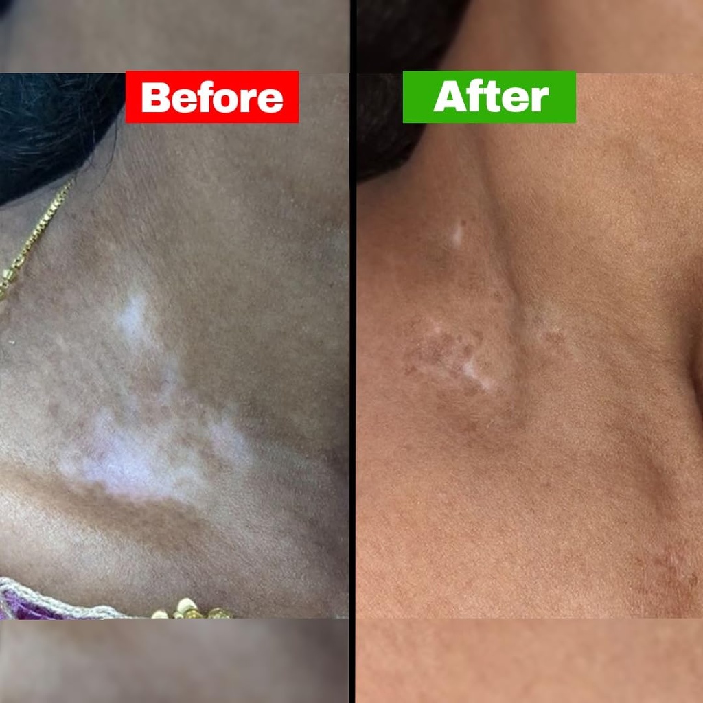 siya-ayurveda-psoriasis-treatment-oil-fo-5.jpg