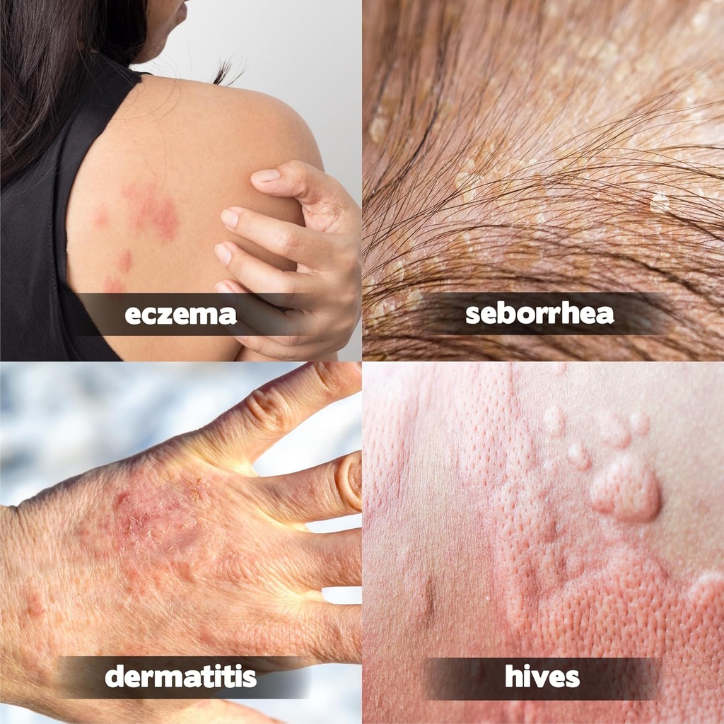 hillvital-eczema-cream-for-kids---hydrat-2.jpg