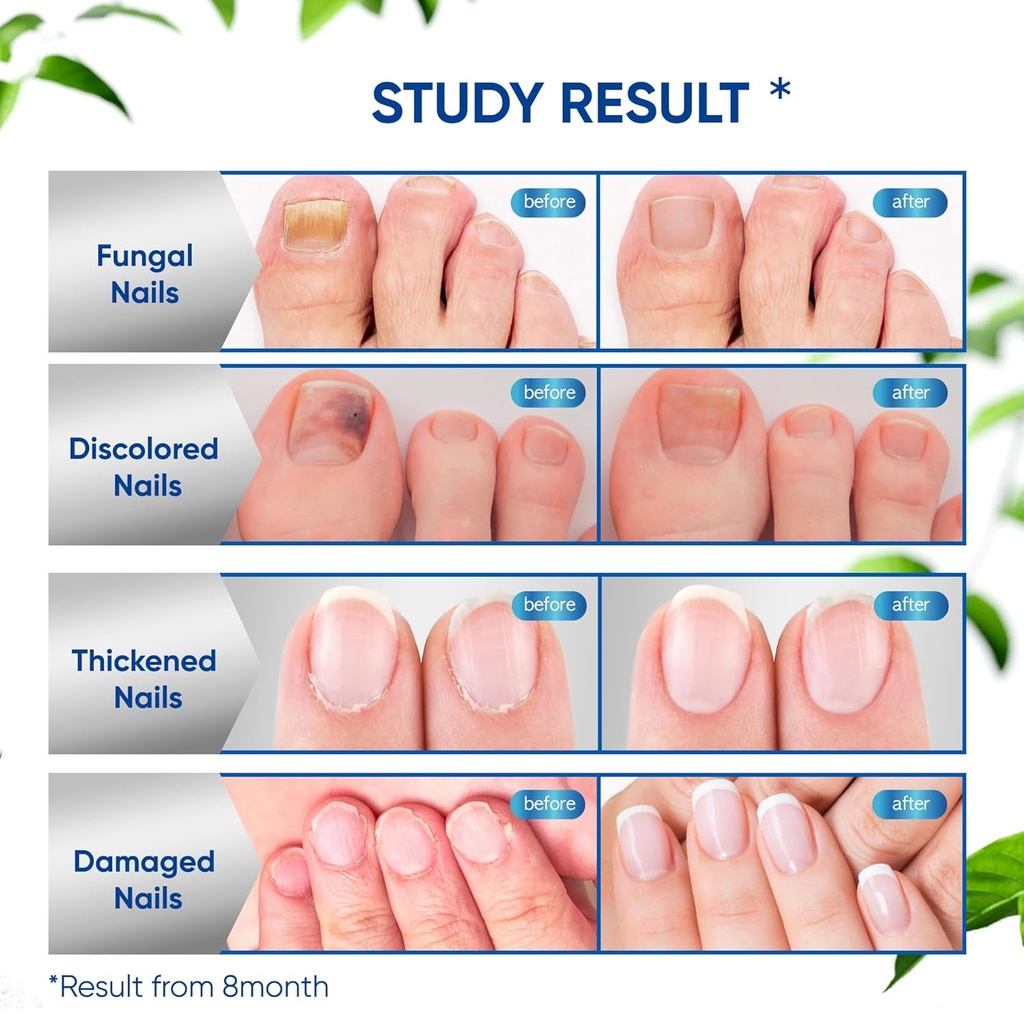 toenail-fungus-treatment-extra-strength--4.jpg