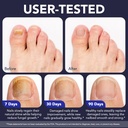 toenail-fungus-pen-toenail-fungus-treatm-6.jpg